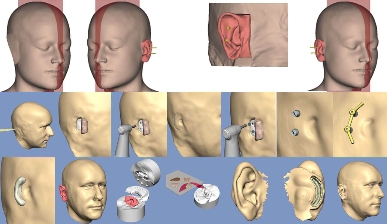 Новые технологии в экзопротезировании | Москва, Одинцово | Center of Surgery