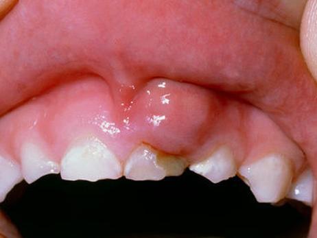 Десна отошла от зуба - почему и что делать?