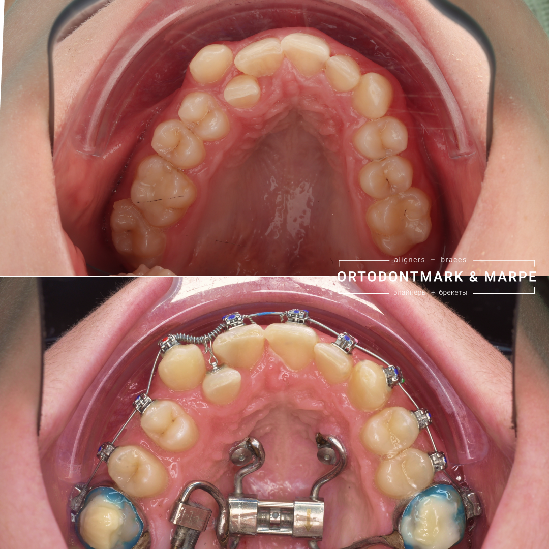 MARPE case result 10
