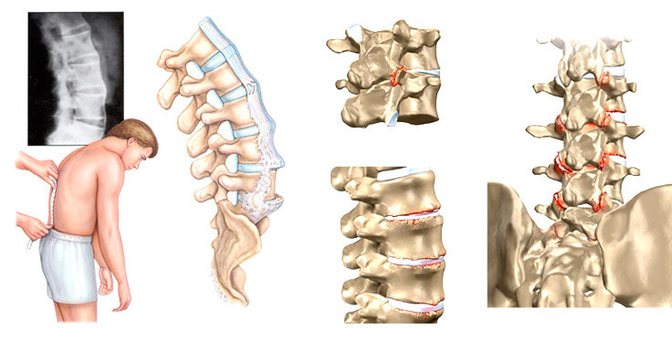 Болезни Спины Фото