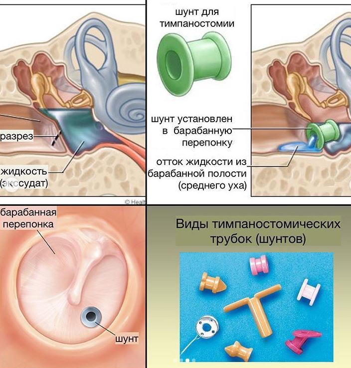 Лечение воспаления среднего уха у взрослых