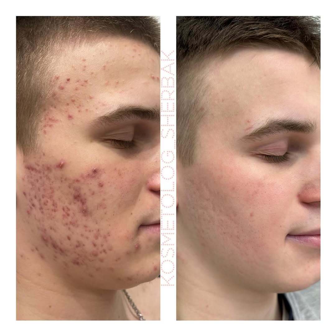 Лечение акне у женщины в клинике PradusCOSMO, СПб. До и после процедуры