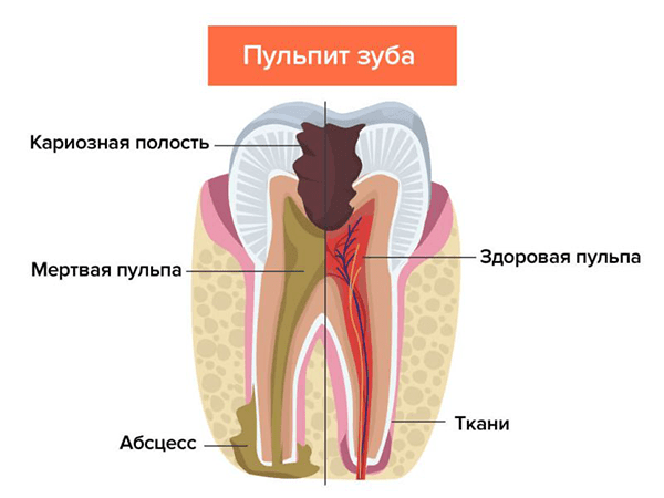 Болит зуб ночью: что делать?