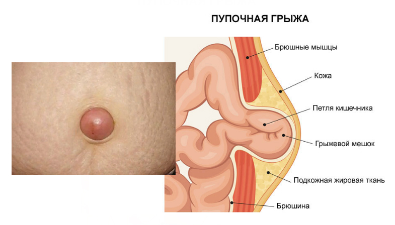 Пупочная грыжа или расширение пупочного кольца?