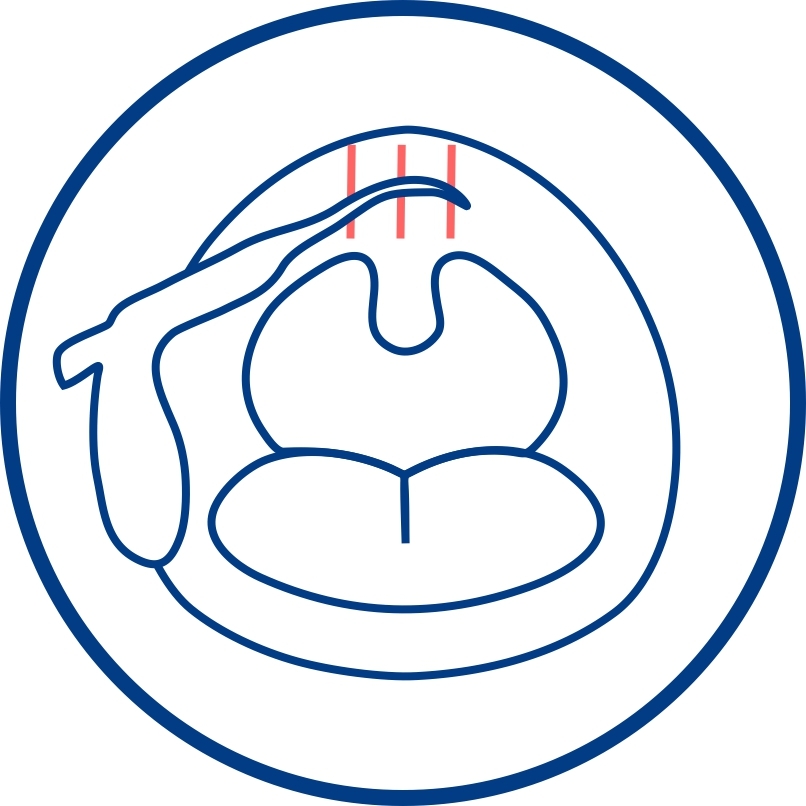 Bipap-терапия и что такое BiPAP-терапия? Его отличие от СИПАП-терапии
