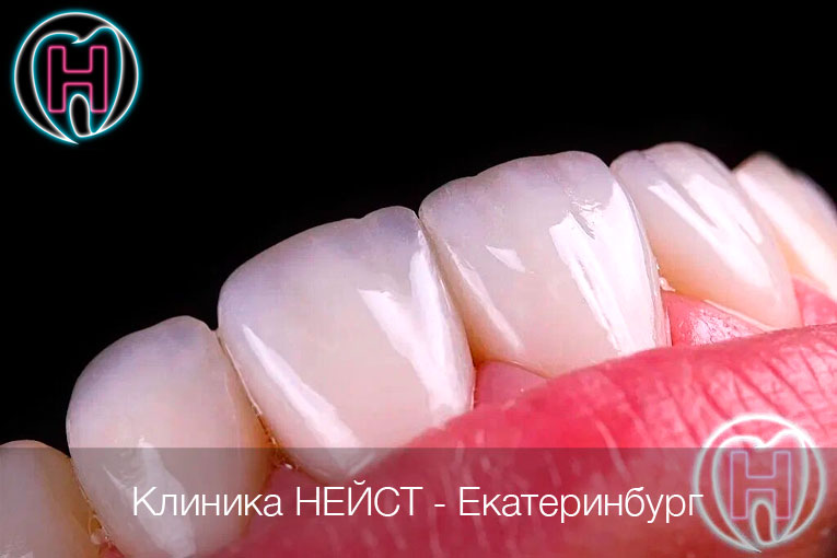 Авторские композитные виниры c прозрачным краем в Екатеринбурге, цвет Блич 4