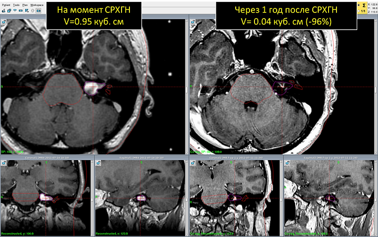 Удаление невриномы слухового нерва. Невринома мосто-мозжечкового угла кт. Клинические диагнозы невринома слухового нерва. Шваннома слухового нерва мкб. Шваннома яремного отверстия на кт.