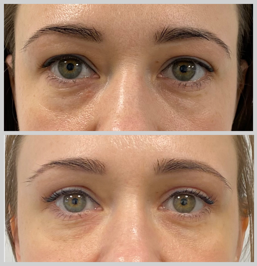 блефаропластика нависшие веки