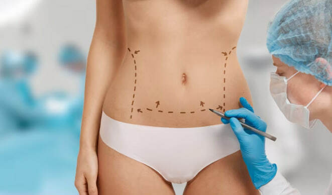 Абдоминопластика для подтяжки дряблой кожи