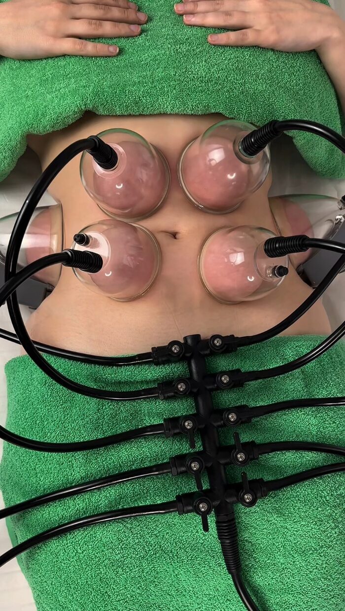 Точечный лифтинг «Паук» для подтяжки кожи лица и тела в А.М Владимир