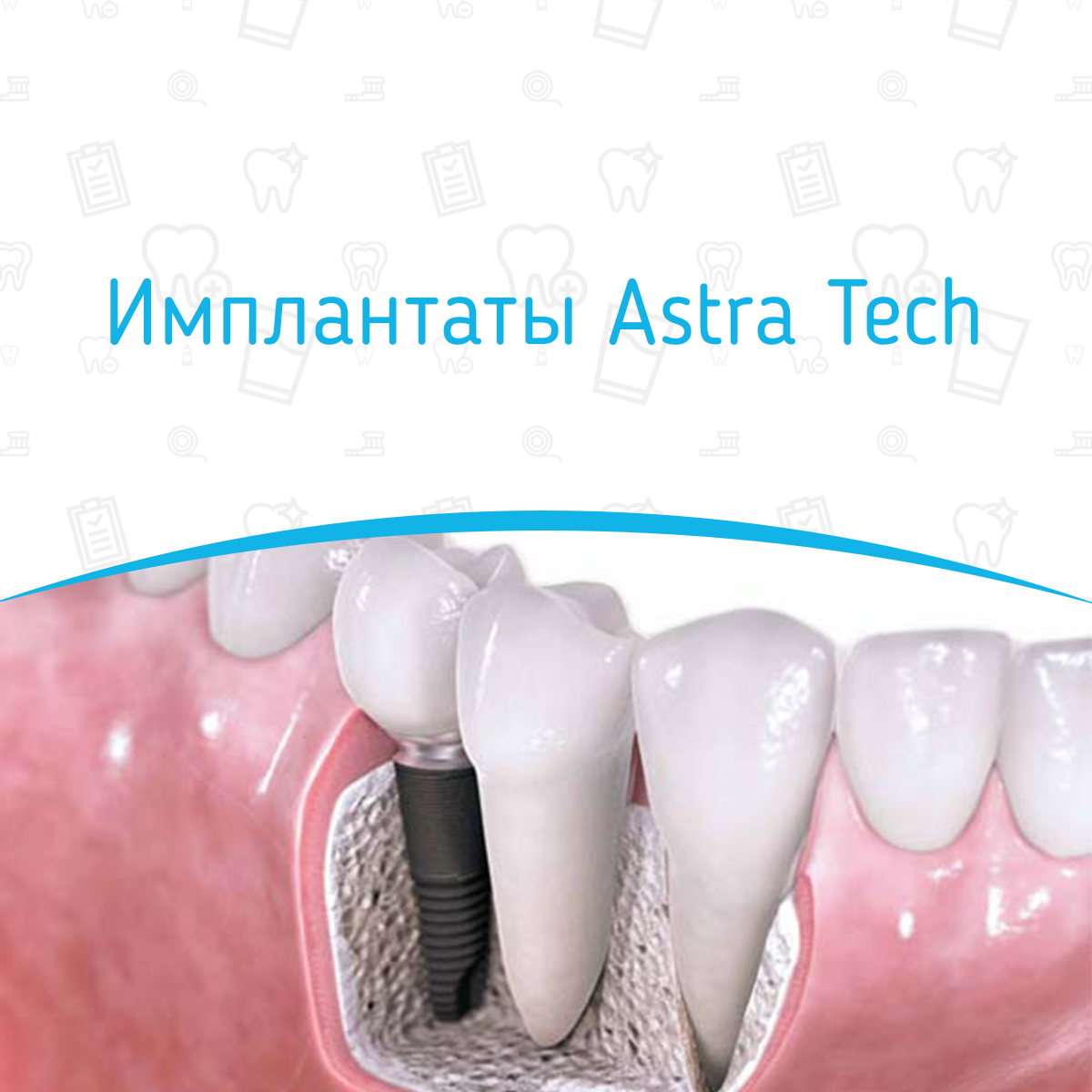 Чит имплант. Astra Tech. Импланты Astra Tech (Швеция). Имплантат Astra Tech с коронкой. Astra Tech скошенный имплант.