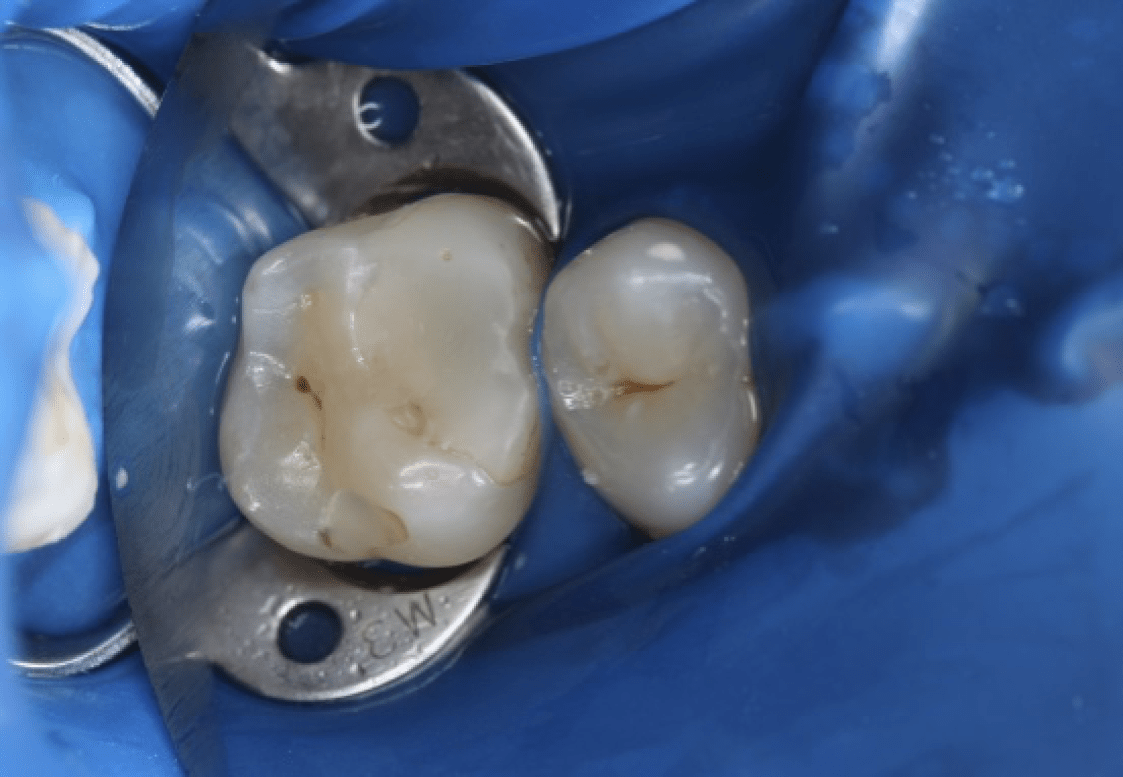 Лечение кариеса зуба - стоматология Раменки