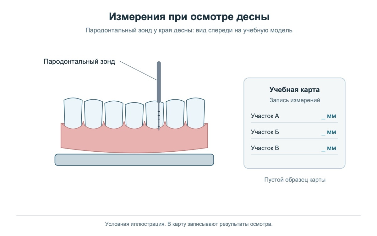 Пародонтальный зонд у края десны на учебной модели и пустая карта измерений