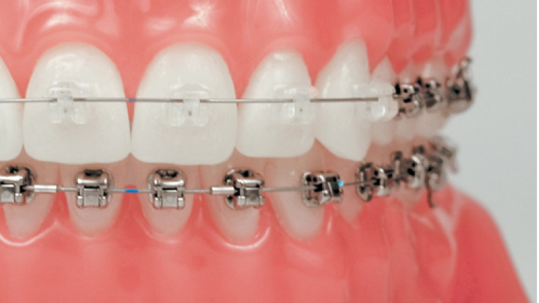 Брекеты Damon Q, исправление прикуса — цены в Дербенте. Стоматология DK