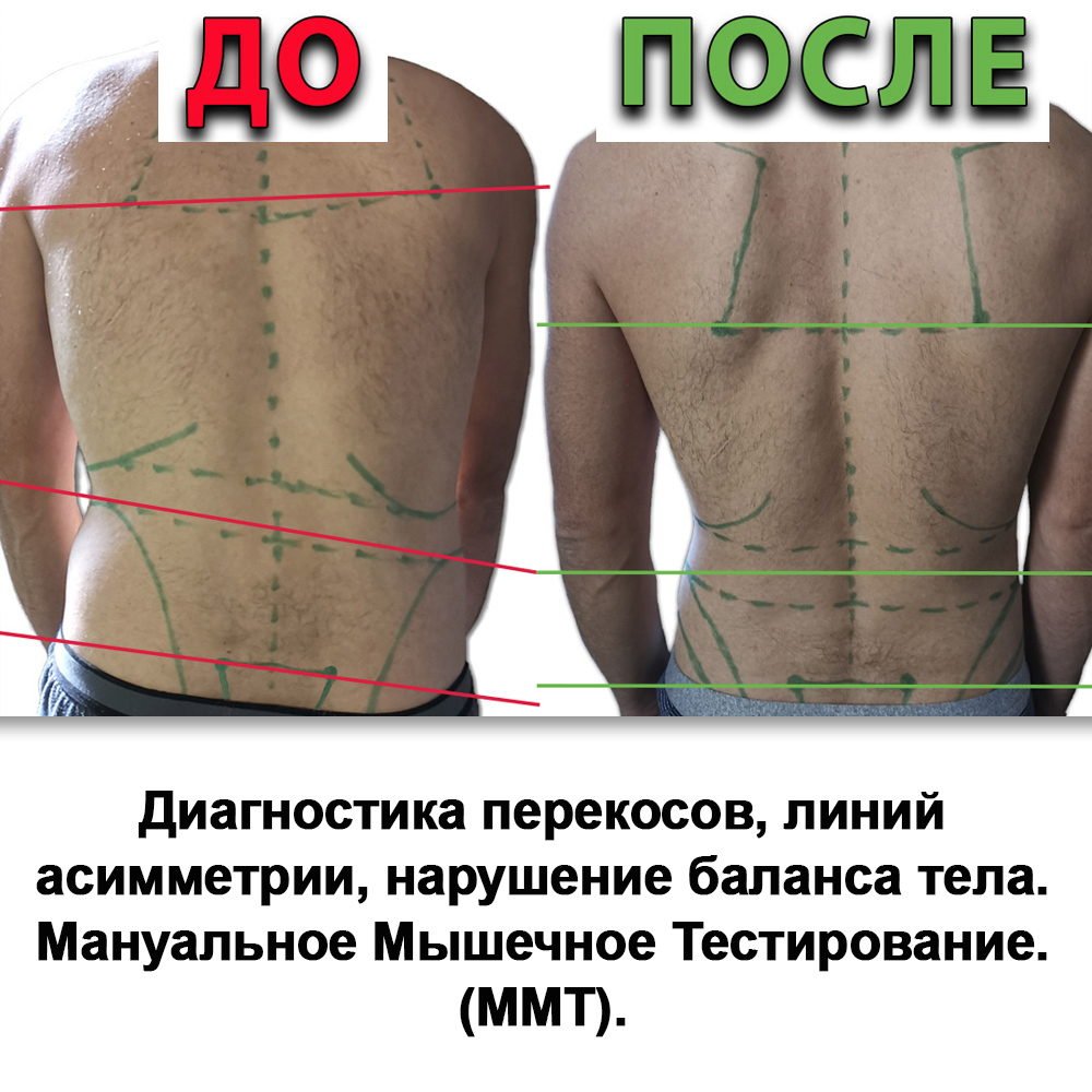 Фото проведения диагностики с нанесением линий перекосов на теле, линий асимметрии, нарушение баланса тела. Мануальное Мышечное Тестирование (ММТ).