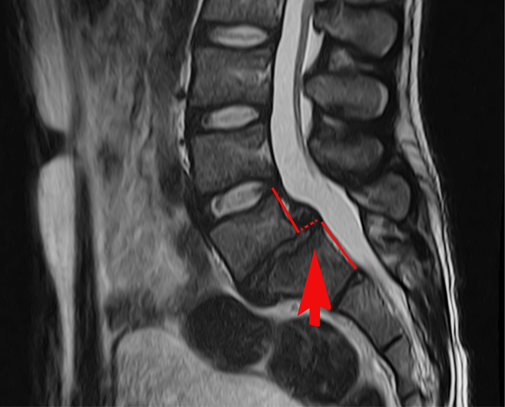 МРТ смещение L5