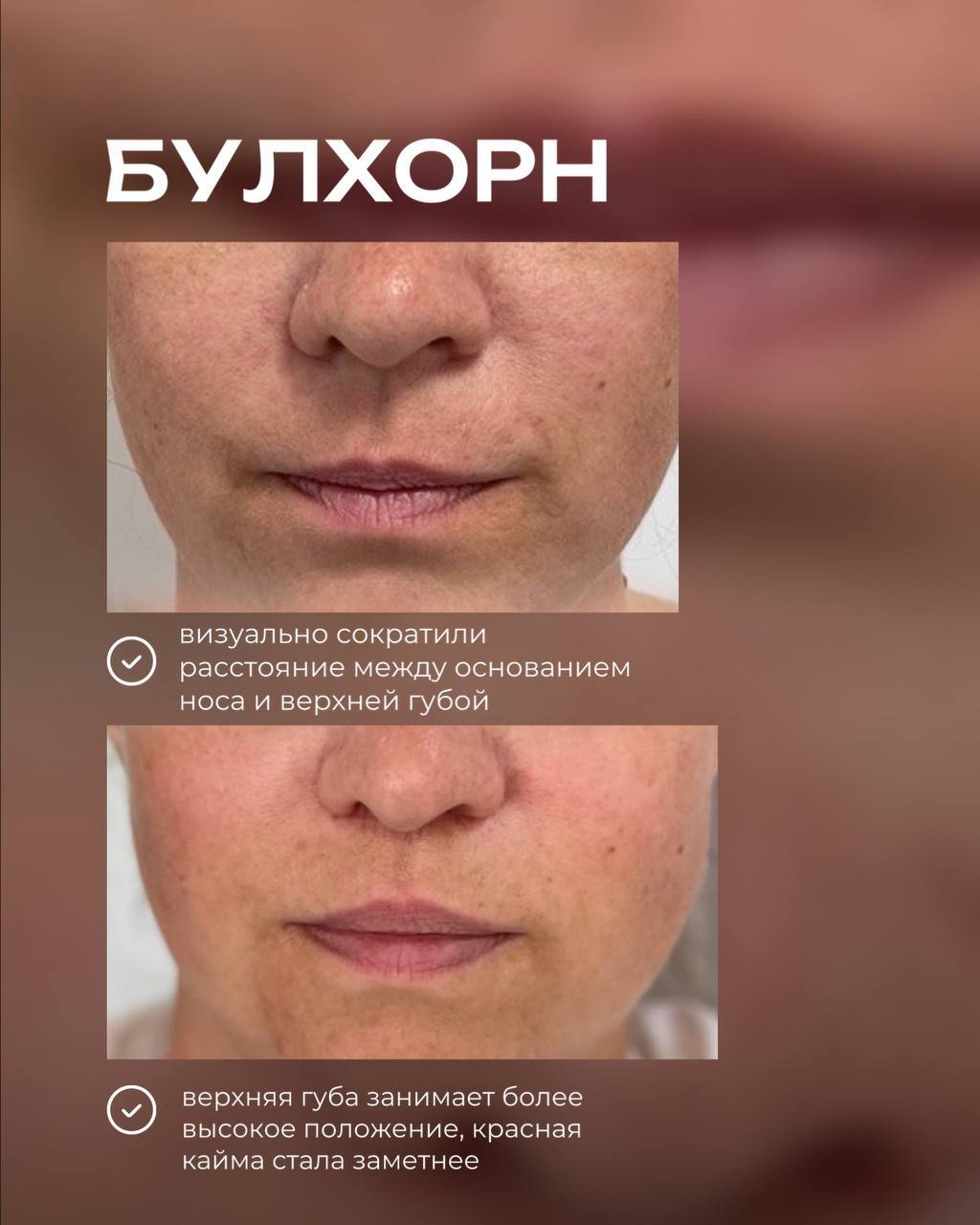 Верхняя блефаропластика и булхорн: фото до и после