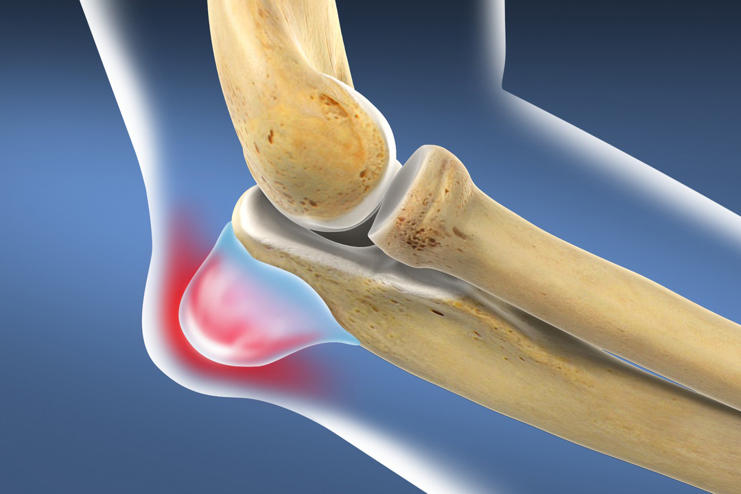 Воспаление связочного аппарата колена — реабилитация