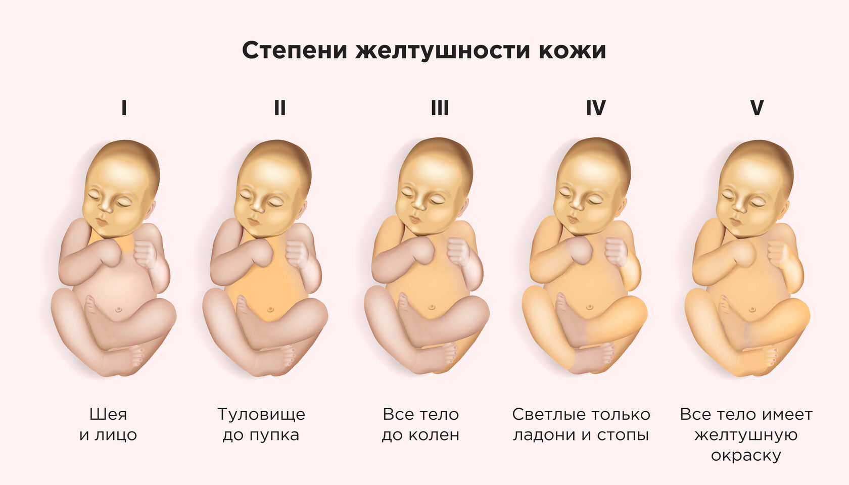 Желтуха у новорожденных: полное описание, симптомы и причины
