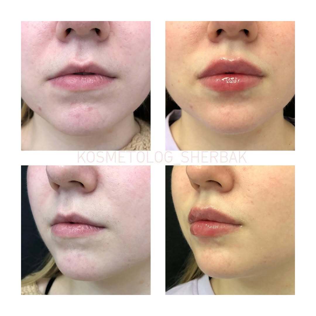 До и после контурной пластики губ. Увеличение объёма без утяжеления. PradusCOSMO, Васильевский остров