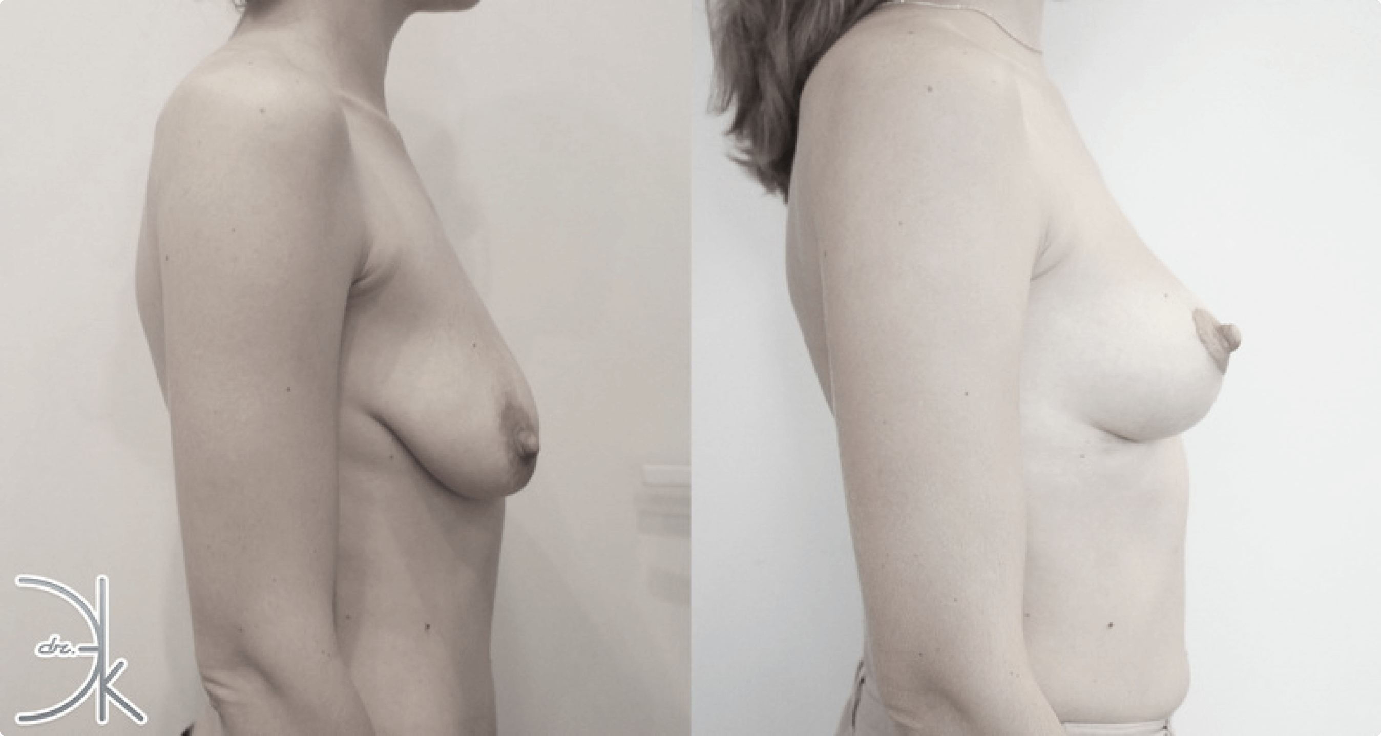 липосакции груди у женщин фото 4