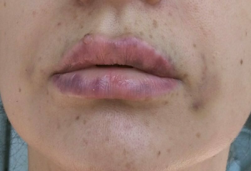 Твердые губы после увеличения: норма или стоит беспокоиться? | New Line  Clinic