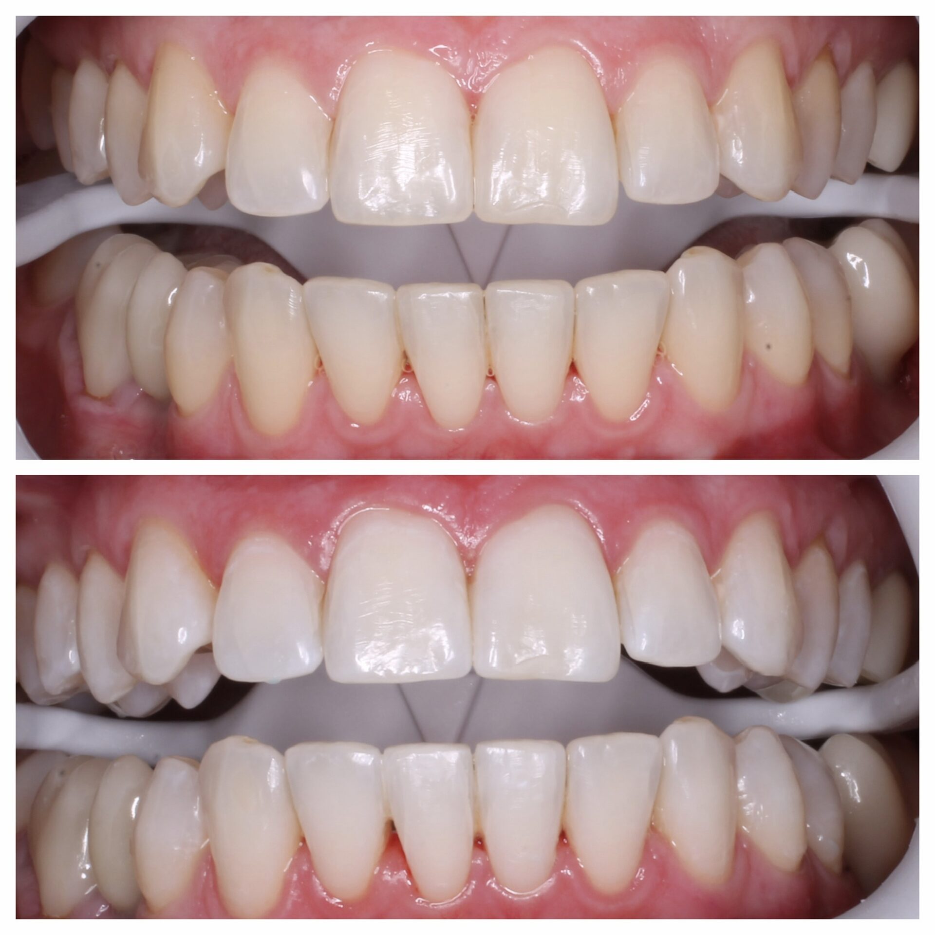 профессиональное отбеливание зубов в чебоксарах,отбеливание зубов в йошкар-оле, лечение зубов