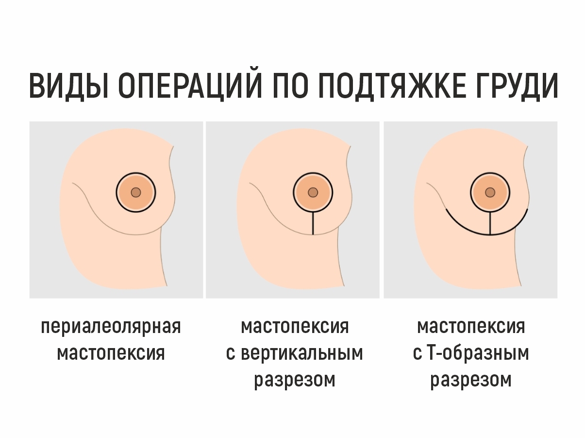 Подтяжка груди в Новосибирске — мастопексия цена в клинике АвисМед