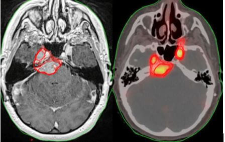 ПЭТ/КТ имеет преимущество над МРТ в диагностике и планировании лучевой терапии мегингиомы