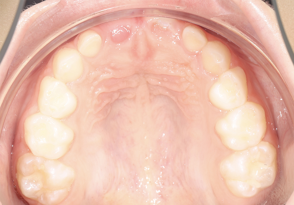 Коррекция открытого прикуса и миофункциональных нарушений у ребенка 7 лет