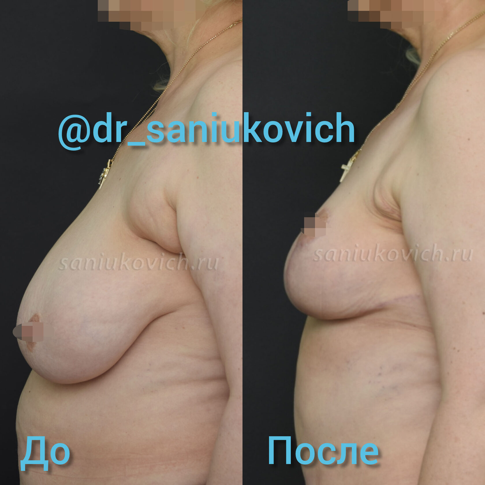 как проходит операция по уменьшению груди у женщин фото 86