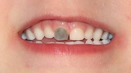 Почему чернеют молочные зубы у детей: причины появления темного налета, лечение.