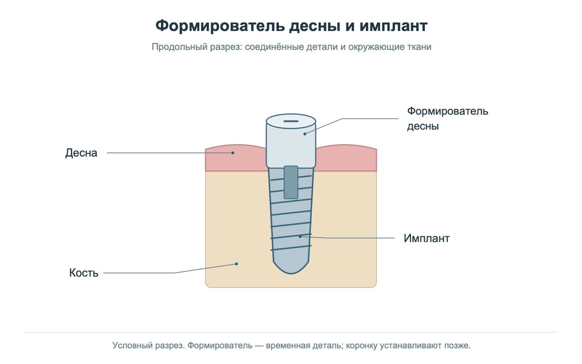 Формирователь десны соединён с имплантом и выступает над мягкими тканями