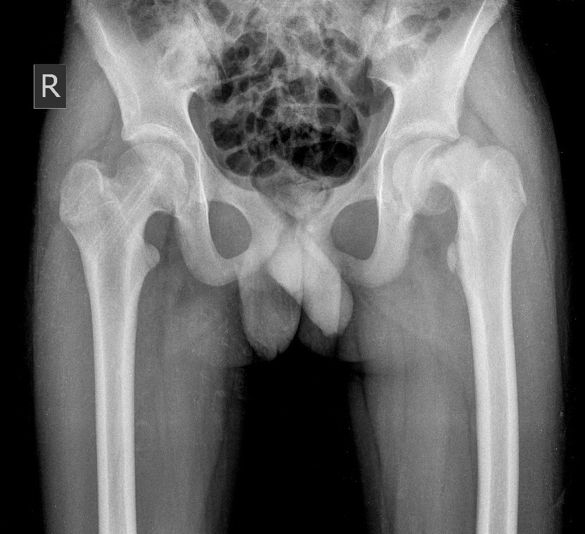 Эпифизарная дисплазия голеней рентген. Юношеский эпифизеолиз головки бедренной кости. Юношеский эпифизеолиз тазобедренного сустава. Эпифизеолиз (перелом Салтера-Харриса);. Юношеского эпифизеолиза головки бедренной кости..