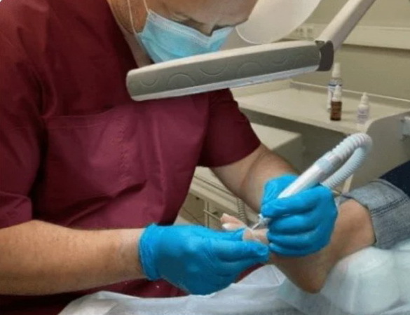 обработка стержневых мозолей