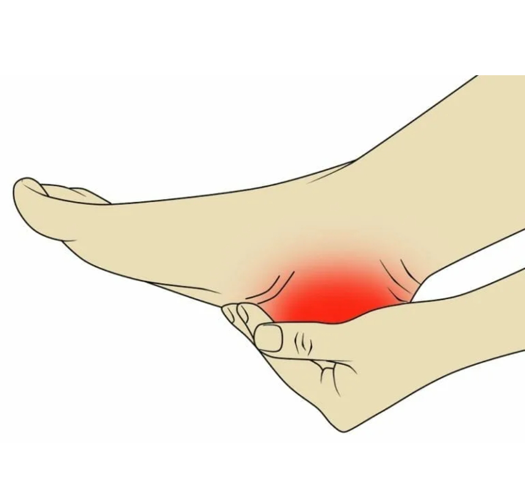 Треснула пятка и болит что делать. Тендинопатия подошвенного апоневроза.