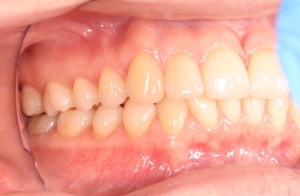 Лечение периодонтита с последующим протезированием зубов коронками из диоксида циркония