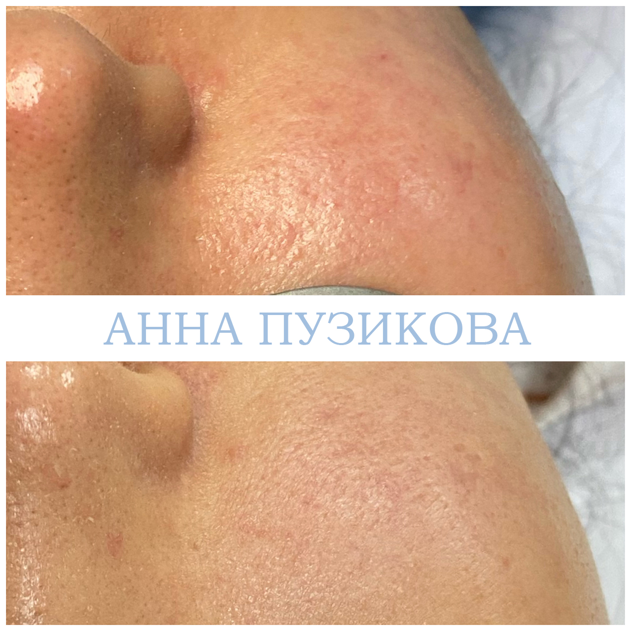 Результат удаления сосудистых звёздочек и купероза на лице с помощью фототерапии ClearLight IPL — врач-косметолог Пузикова Анна Анатольевна, Санкт-Петербург