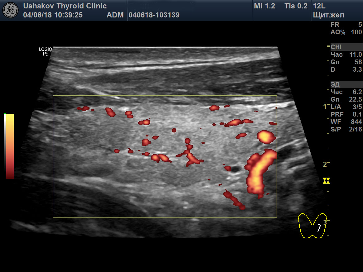 Клинический «ПРОТОКОЛ УЗИ ЩЖ» №1