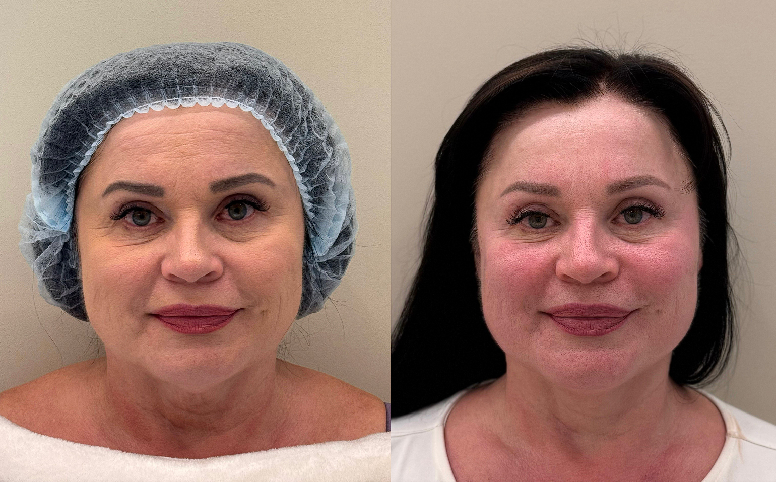 Пациентка Skinsense после одного сеанса моделирующего массажа