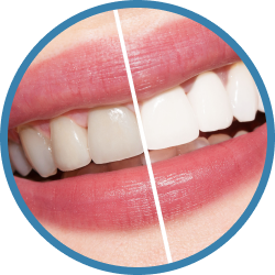 Установка имплантов в Дербенте. Имплантация при отсутствии одного зуба.