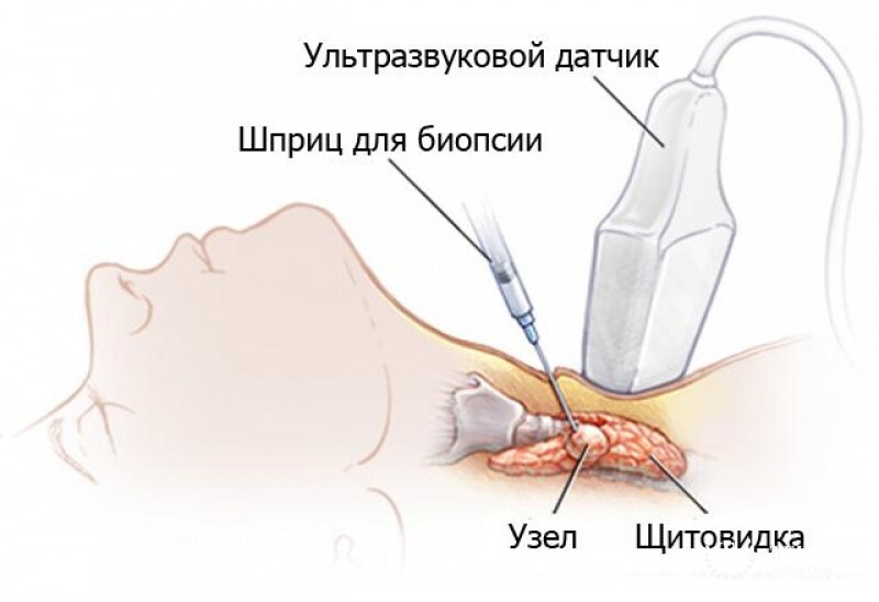 Биопсия щитовидной железы: виды