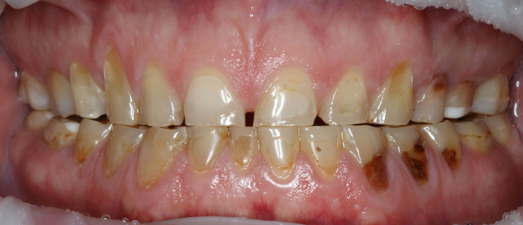 Состояние зубов до лечения и установки виниров в клинике Пробел