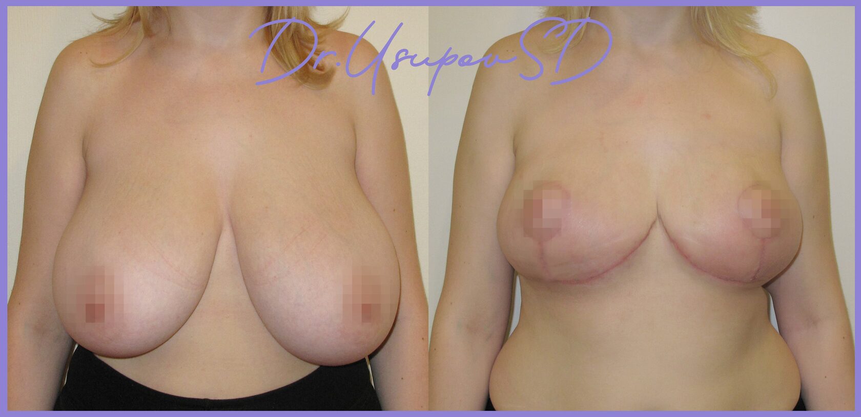 уменьшение груди у женщин причины фото 3