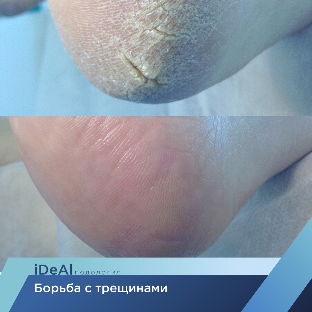 Борьба с трещинами на стопах