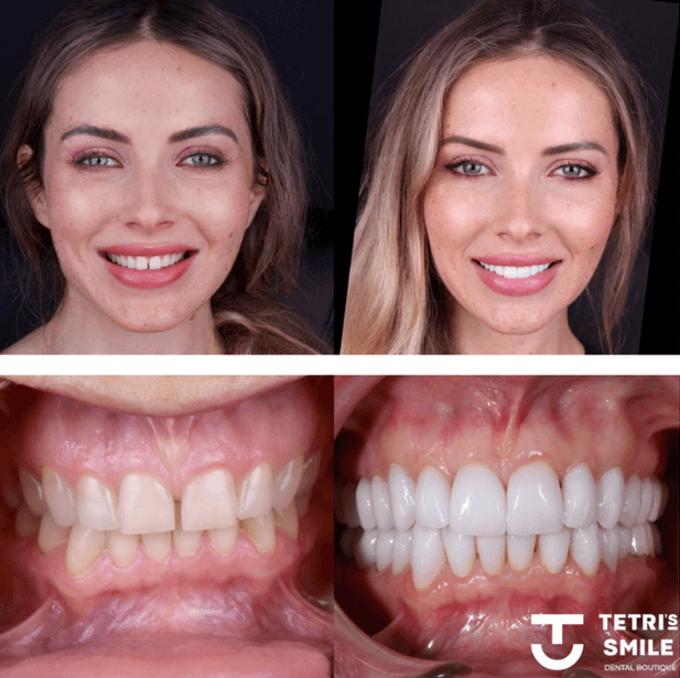 Dental porcelain veneers Miami, FL cost