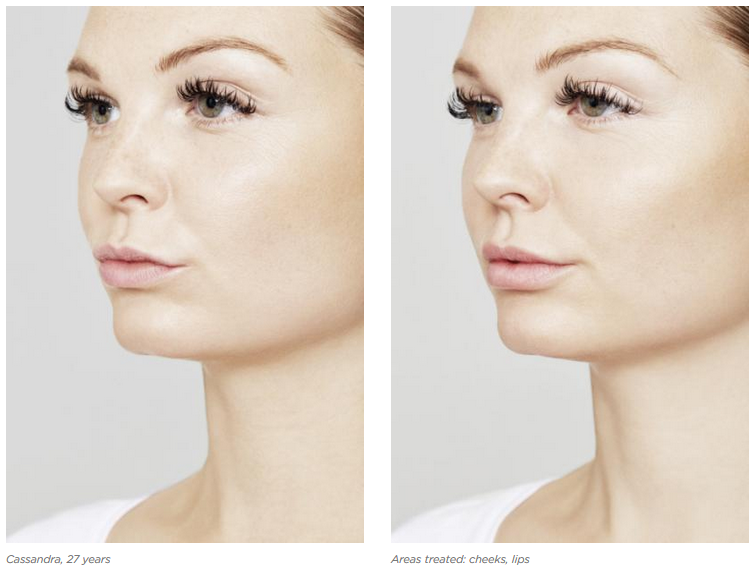 CONTOURING CORRECTION (FILLERS VICROSS JUVEDERM, RESTYLANE)