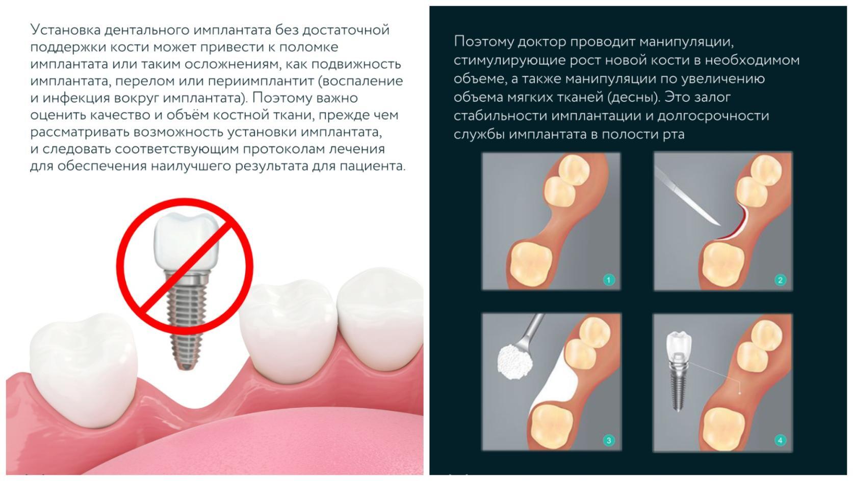 Имплантация зубов при отсутствии костной ткани (атрофии)