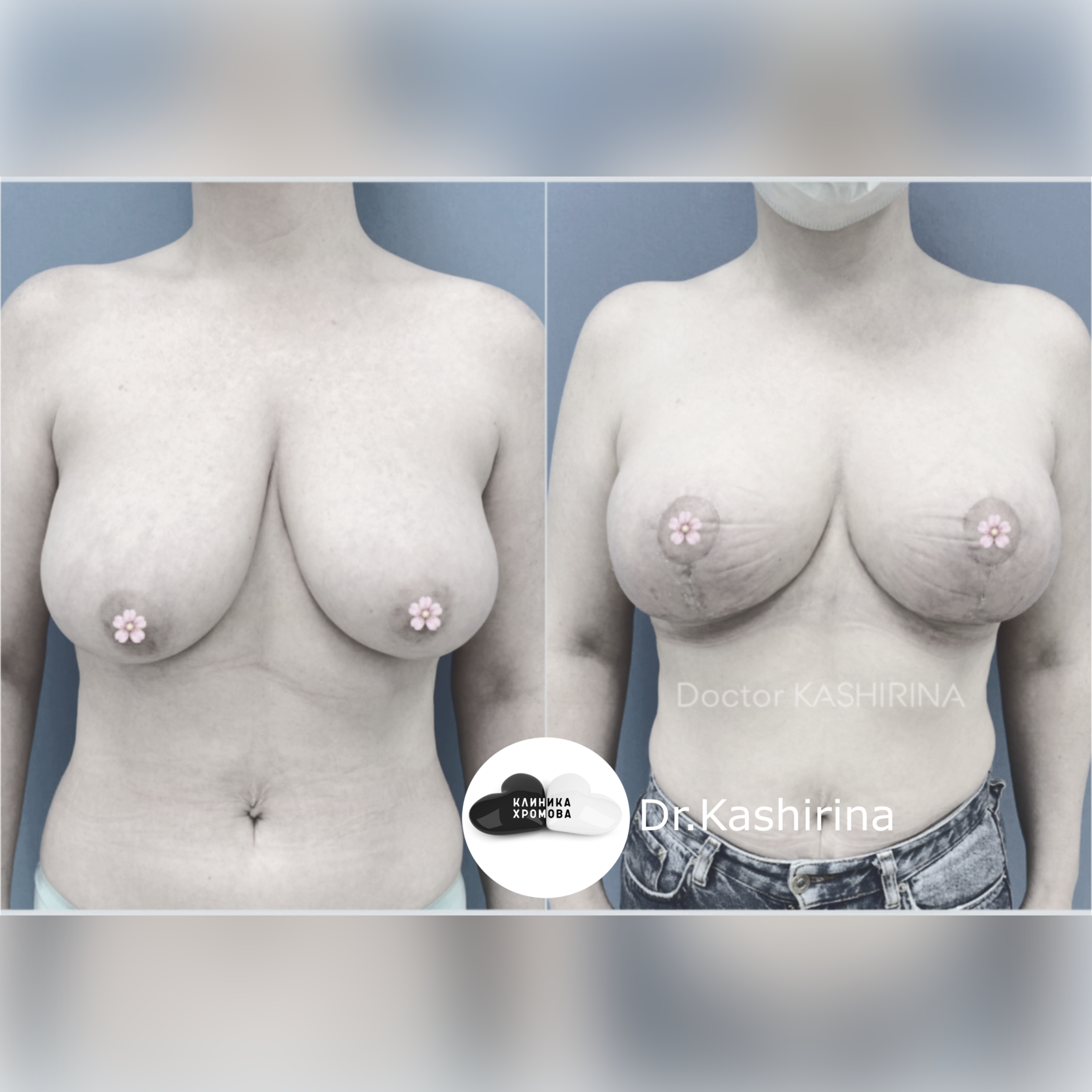 операция по подтяжке груди у женщин фото 113