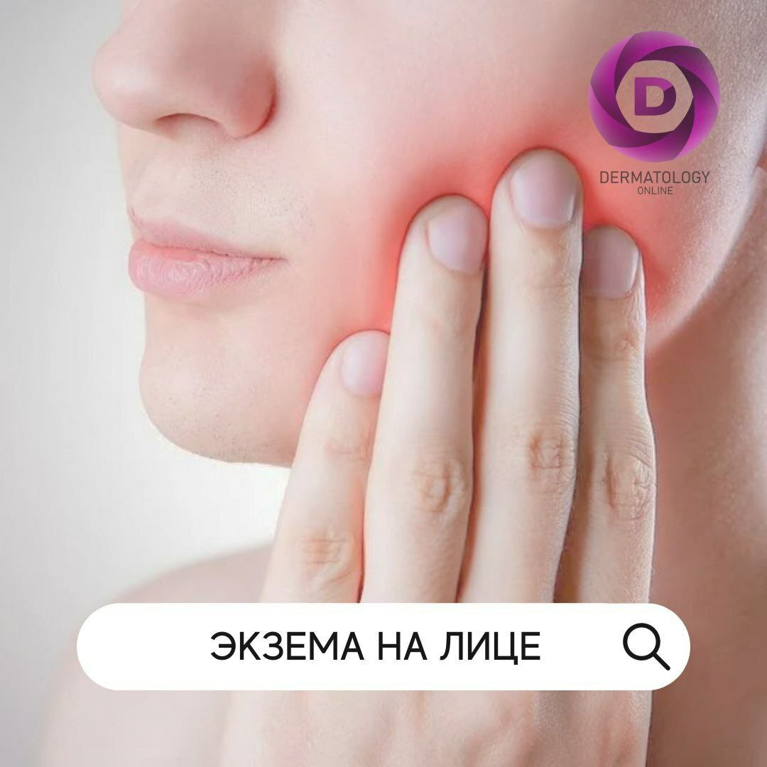 Экзема на лице, причины, лечение, консультация